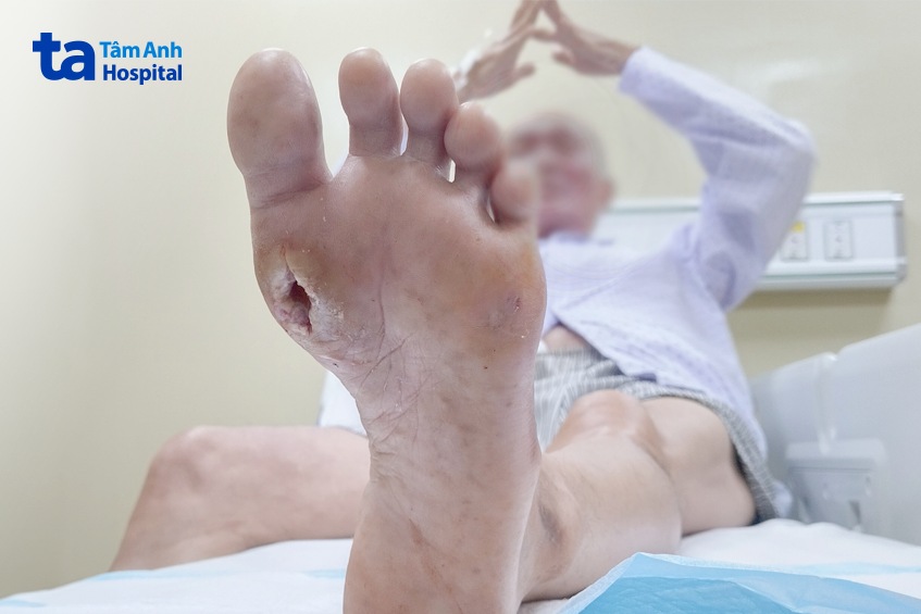 Vết chai chân của ông P. sau khi được cắt lọc các mô hoại tử