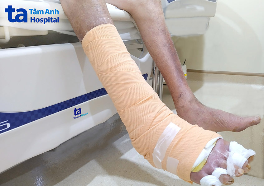 Vết thương của ông B. kéo dài từ bắp chân xuống bàn chân được chăm sóc hàng ngày