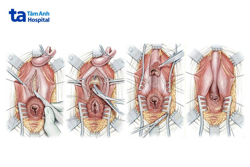 ảnh minh họa phẫu thuật tạo hình niệu đạo