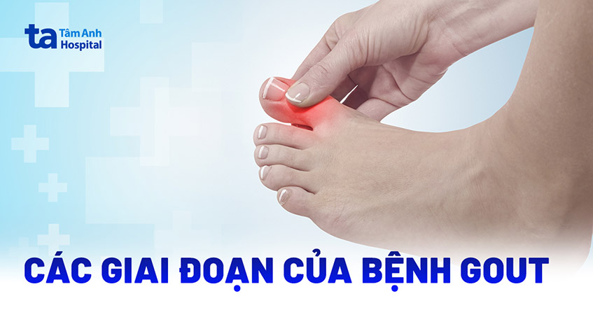 Các giai đoạn của bệnh gout phổ biến và dấu hiệu dễ nhận biết