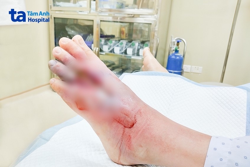 Chân của bà M. bị hoại tử sâu, cần cắt lọc