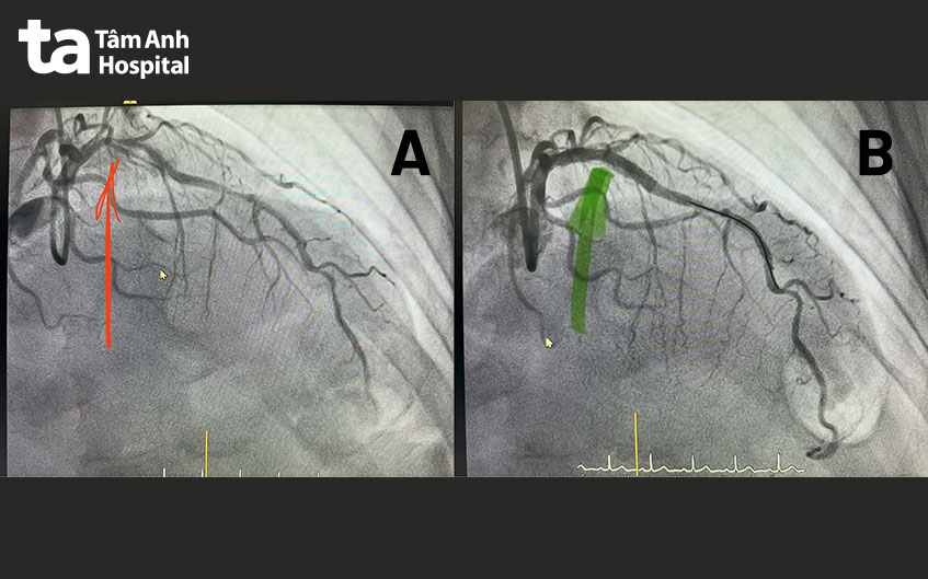 Đoạn liên thất trước bị tái hẹp sau 19 năm đặt stent (hình A) và sau khi được tái thông nhờ đặt stent mới
