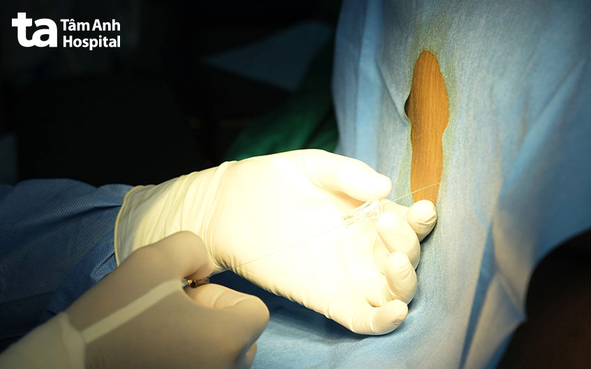 gây tê màng cứng giúp giảm đau