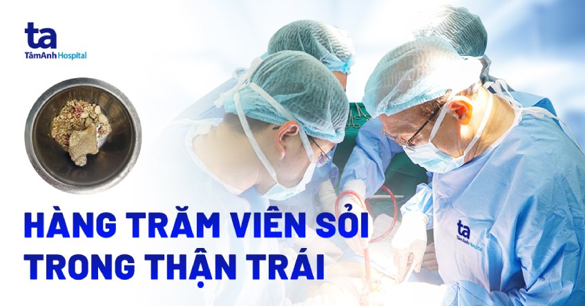 hàng trăm viên sỏi thận trong thận trái