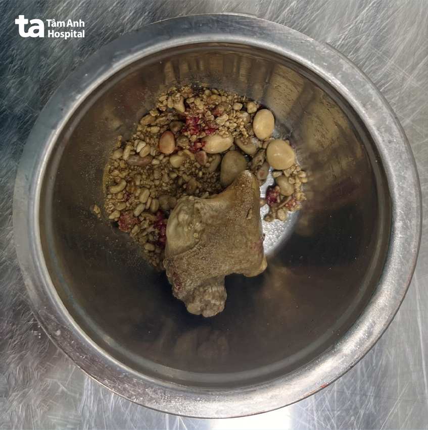 hàng trăm viên sỏi