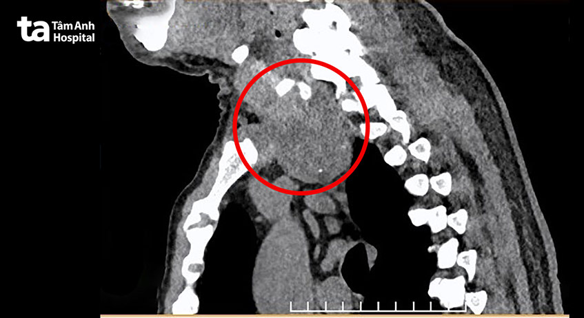Hình ảnh CT ngực cho thấy bướu giáp sa xuống trung thất