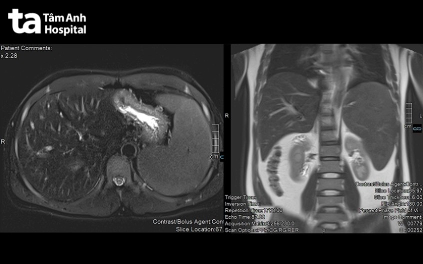 hình ảnh mri gan ứ sắt