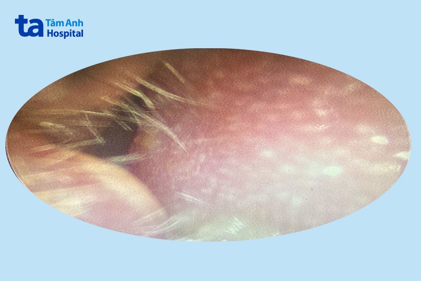 hình ảnh nội soi ống tai phải