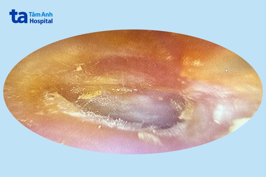 hình ảnh nội soi ống tai trái