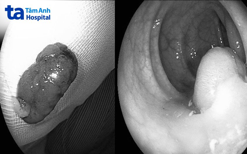 hình ảnh polyp 2cm