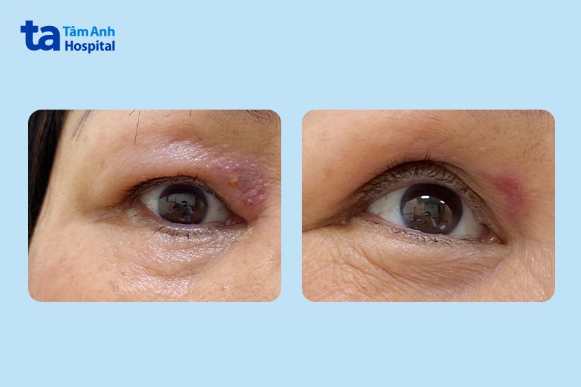 mắt bệnh nhân trước và sau khi điều trị