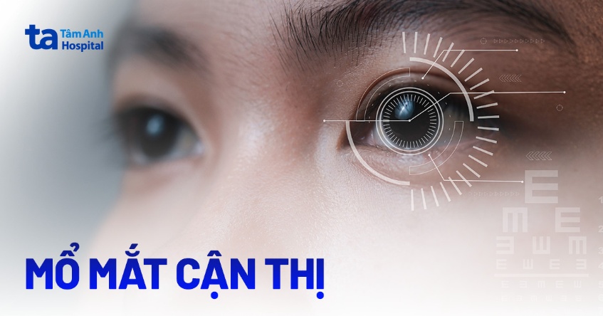 Mổ mắt cận thị: Công dụng, chỉ định, quy trình và chăm sóc phục hồi