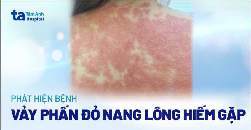 phát hiện vảy phấn đỏ nang lông hiếm gặp