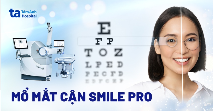 Mổ mắt cận SMILE Pro: Phương pháp, quy trình và chỉ định phẫu thuật