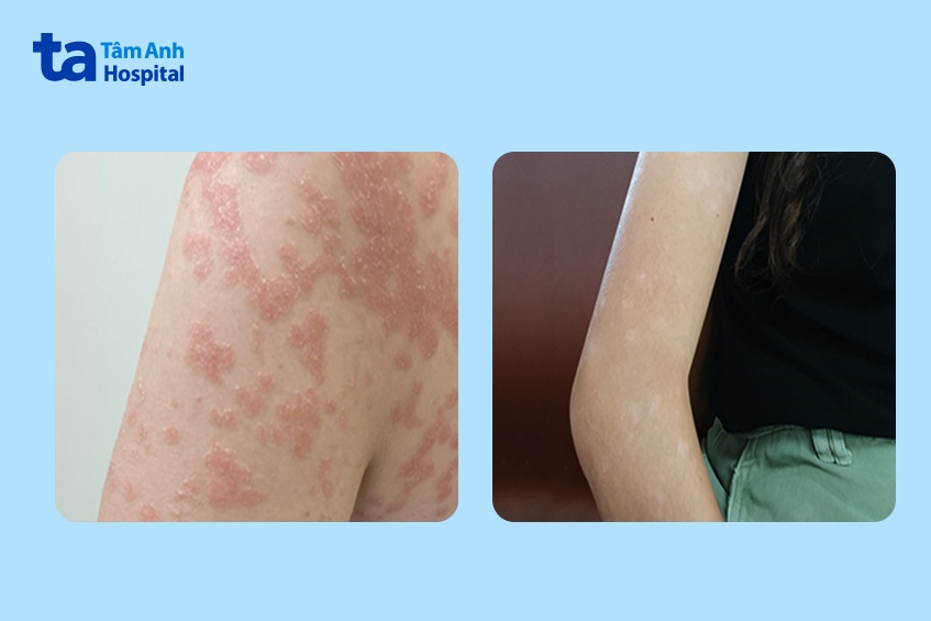 tay người bệnh trước và sau khi điều trị