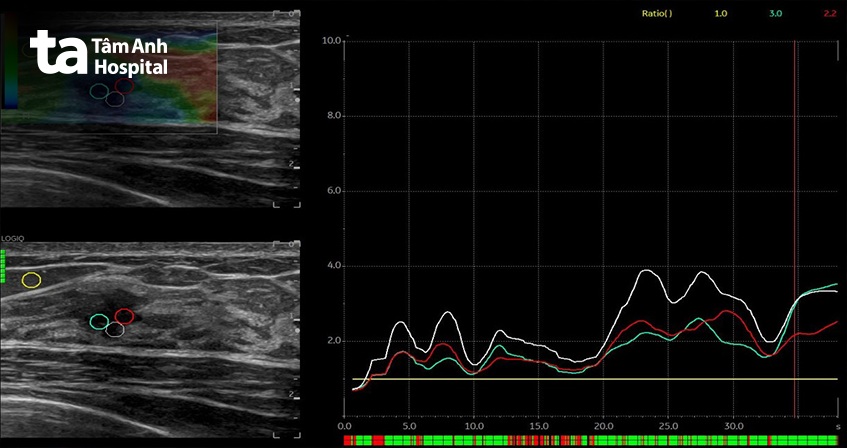 Truy tìm ung thư mới chớm