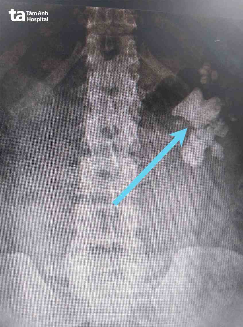 vị trí sỏi trong thận trái của bệnh nhân