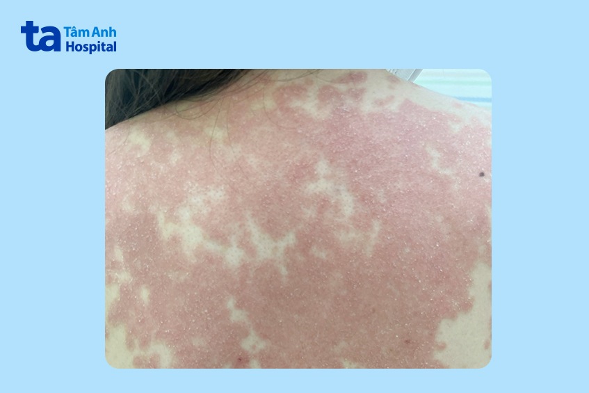 vùng lưng chị H.