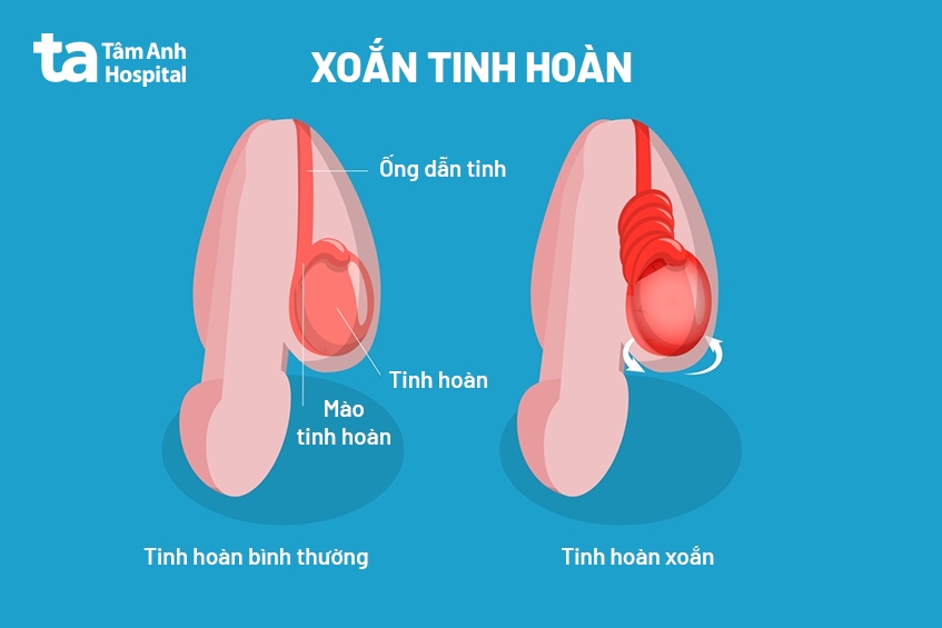 xoắn tinh hoàn ảnh minh hòa