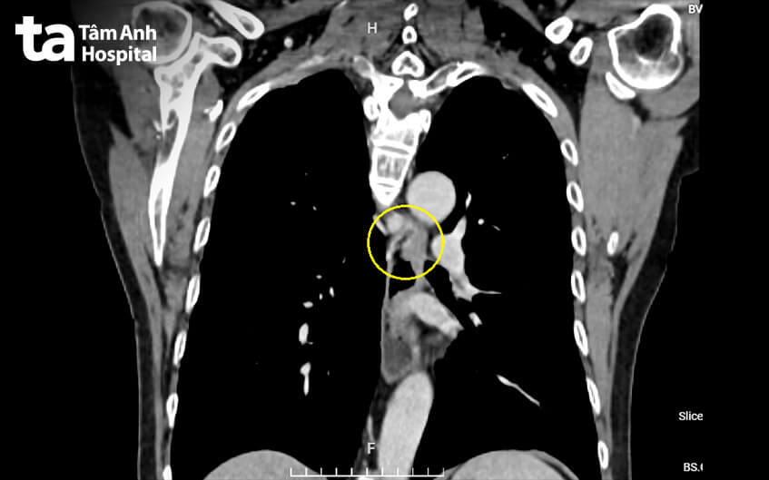 ảnh chụp ct khối u