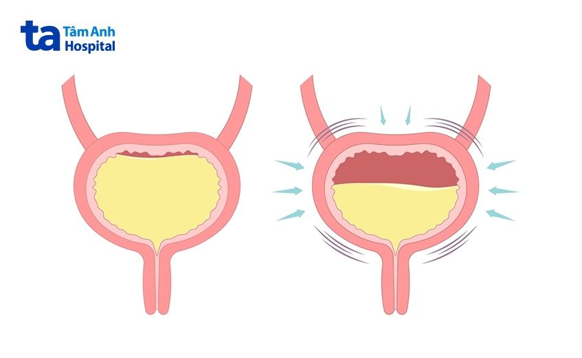 ảnh minh hoạt bàng quang tăng hoạt