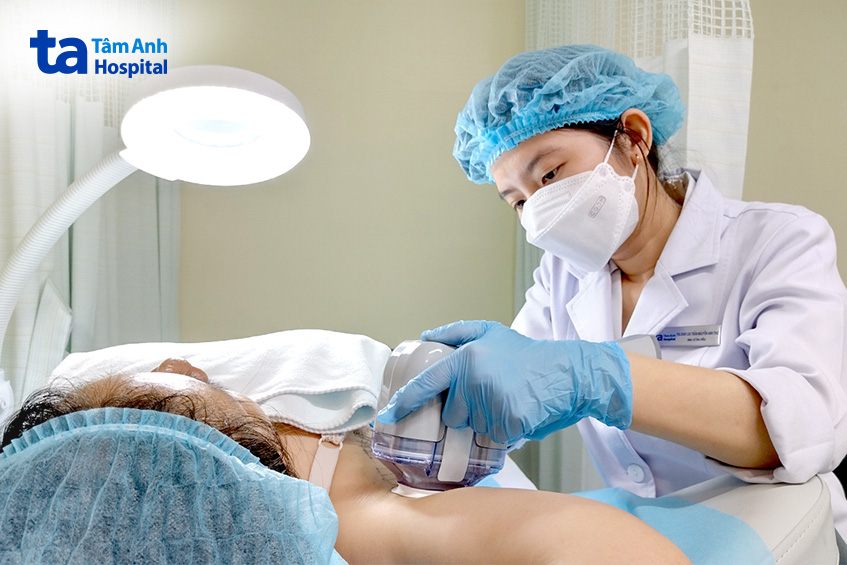 bác sĩ thực hiện triệt tuyến mồ hôi nách cho khách hàng