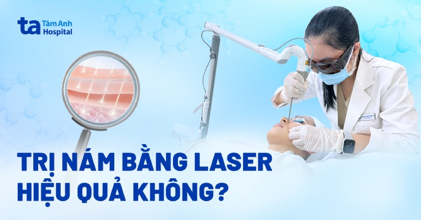 Bắn laser trị nám có hiệu quả không? Khi nào nên lựa chọn?