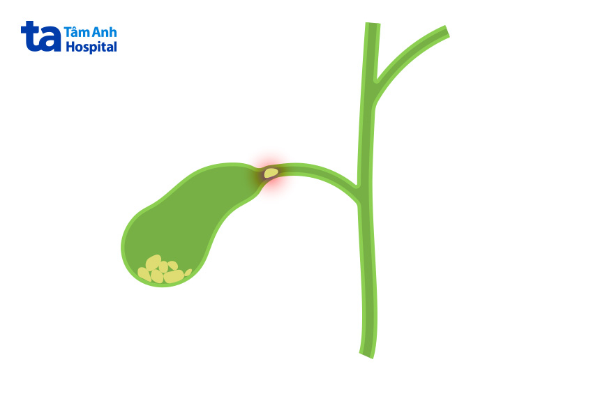 bệnh tắc ống mật