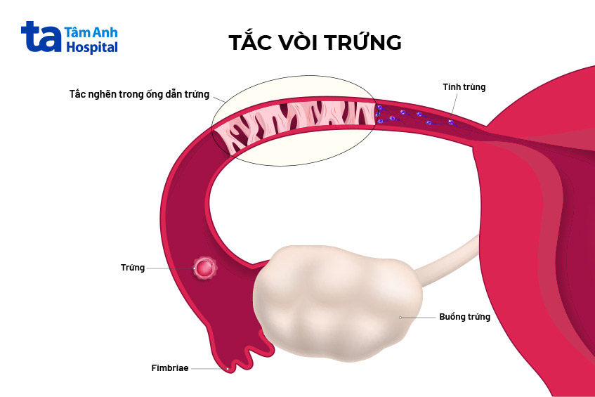 Bị tắc vòi trứng có chữa trị được không?