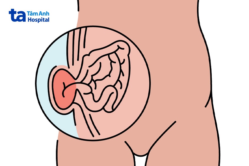 bị thoát vị kẹt