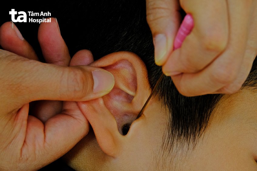 biến chứng chảy máu tai