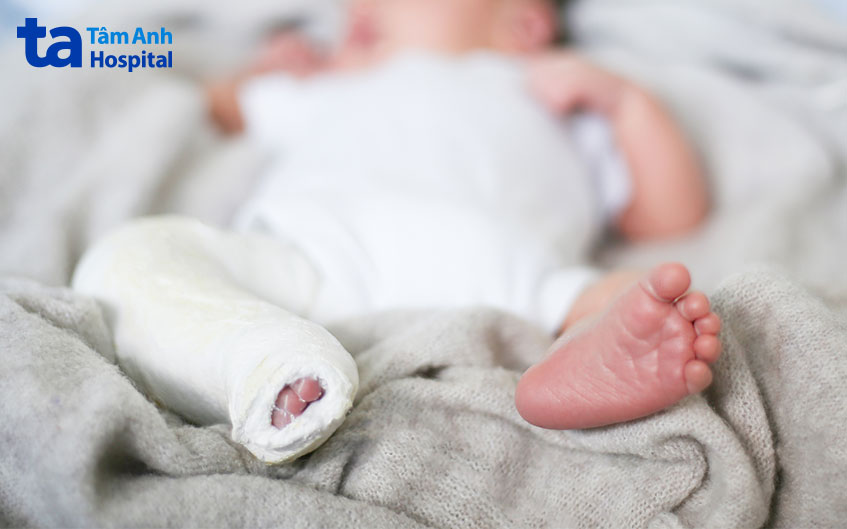 Bệnh nhi bó bột khoảng 5–8 tuần