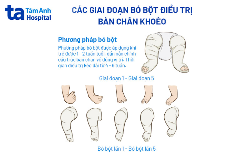Bó bột chân cho trẻ