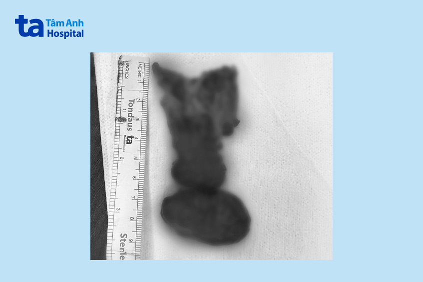 Bướu cổ thòng trung thất được lấy ra từ cơ thể chị T. Ảnh: BVĐK Tâm Anh TP.HCM