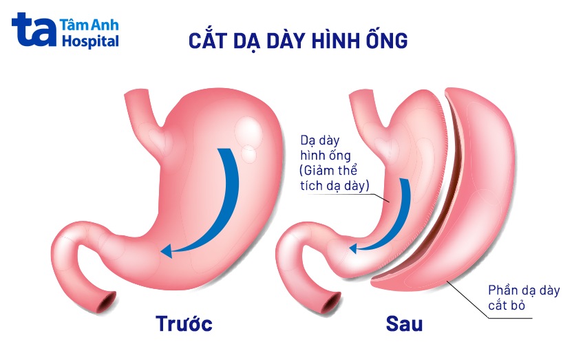 cắt dạ dày hình ống