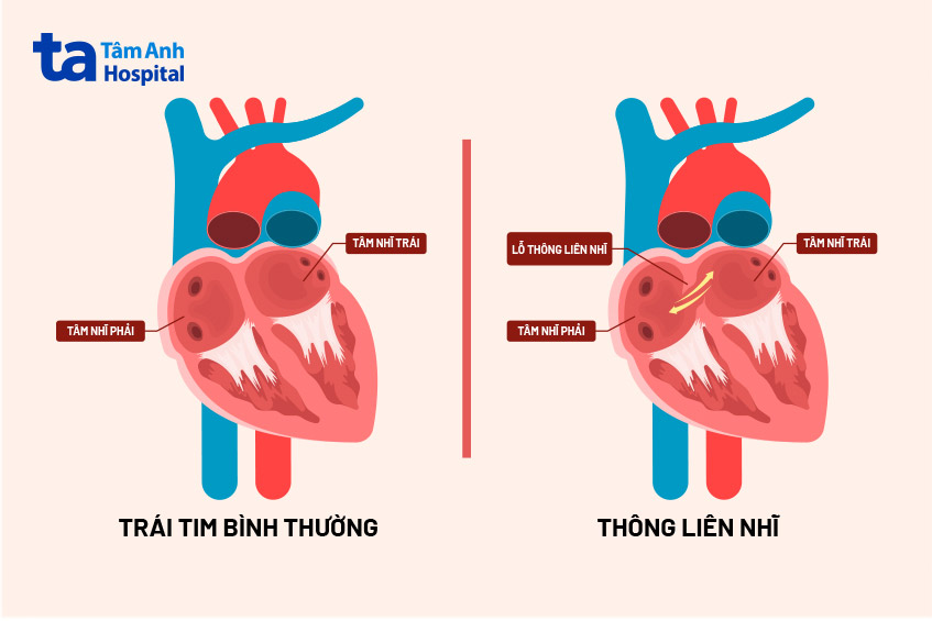 Cấu trúc tim bình thường và cấu trúc tim thông liên nhĩ