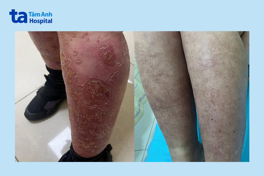 chân chị k trước và sau khi điều tị