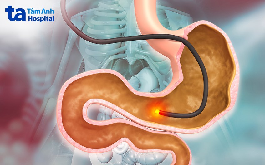 chẩn đoán bệnh gist dạ dày