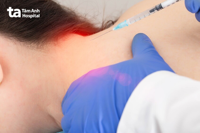 chẩn đoán đau dây thần kinh chẩm