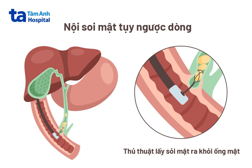 chẩn đoán tắc ống mật