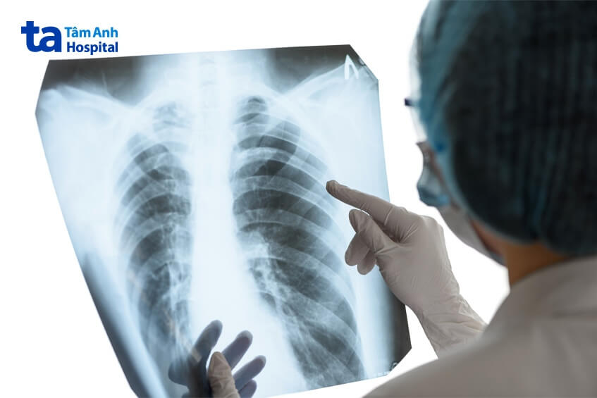 chẩn đoán ung thư bằng phương pháp x-quang