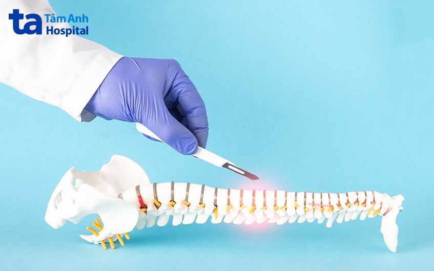 chỉ định mổ u tủy sống ở đâu tốt