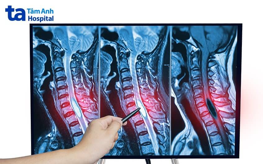 chỉ định phẫu thuật khối u cột sống