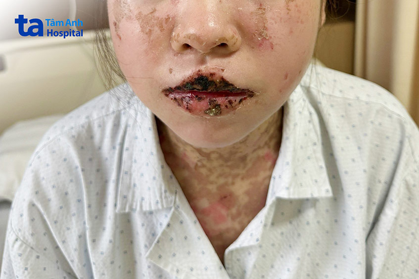 Chị Đinh Huyền sau 10 ngày ngày phục hồi, các dấu hiệu tổn thương da sẽ dần mờ theo thời gian