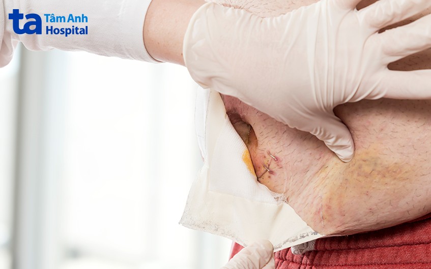 chữa thoát vị thành bụng