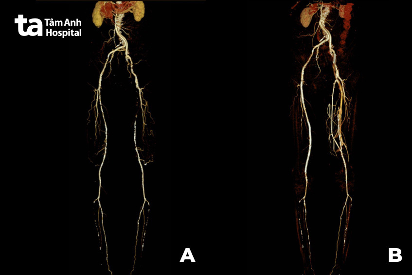 Phim chụp MSCT mạch máu cho thấy động mạch hai chi dưới tắc nghẽn và vôi hóa nặng (hình A) và sau khi được can thiệp tái thông (hình B)
