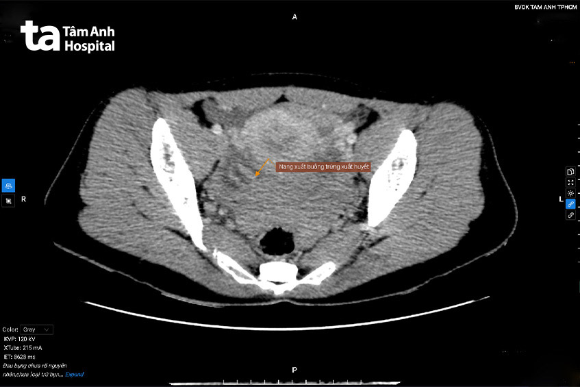 Hình ảnh CT nang buồng trứng xuất huyết