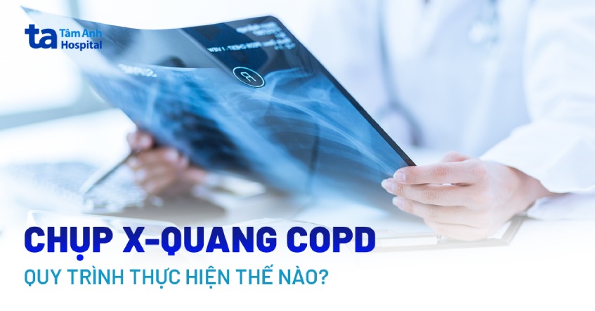 Chụp x-quang COPD: Quy trình thực hiện và các lưu ý cần biết