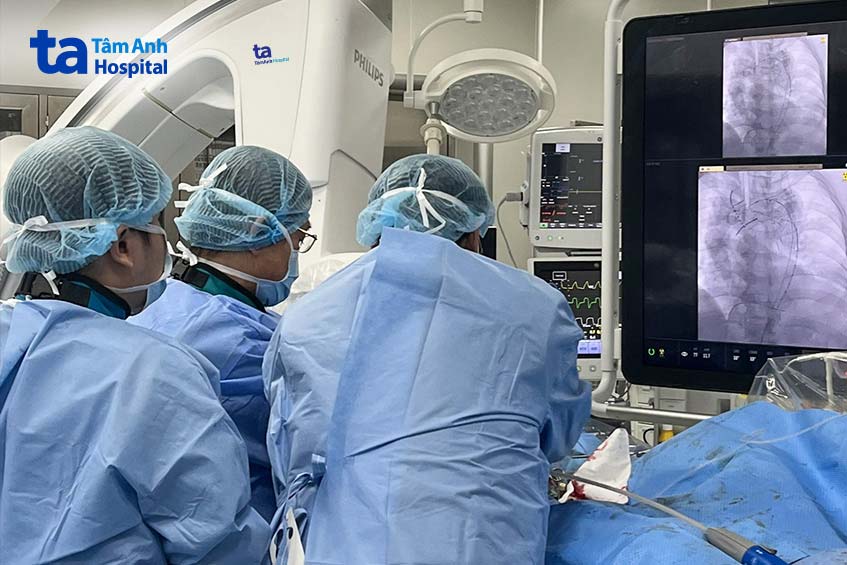 Các bác sĩ đặt stent graft vào đoạn mạch tổn thương, ngăn ngừa nguy cơ vỡ túi phình cho người bệnh