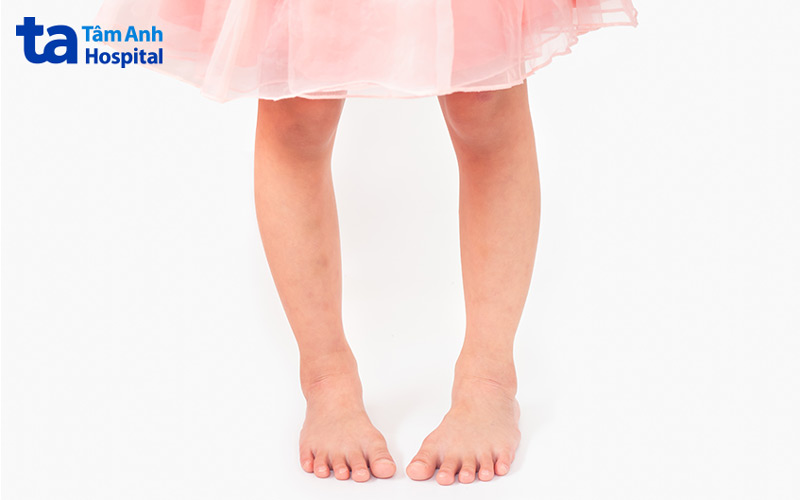 Đi lại hạn chế ở trẻ